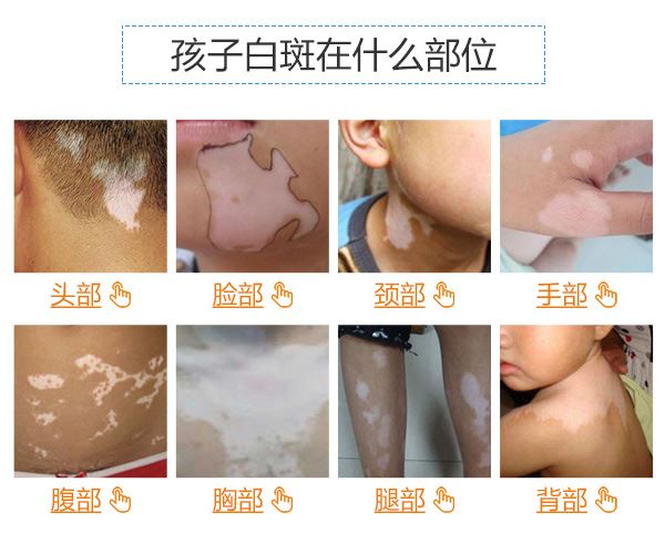 颈部白癜风的治疗常识